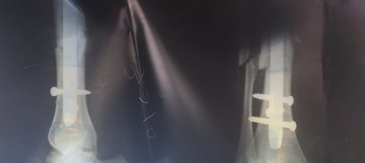 Person #1- Knee Surgery X Ray Scan 2