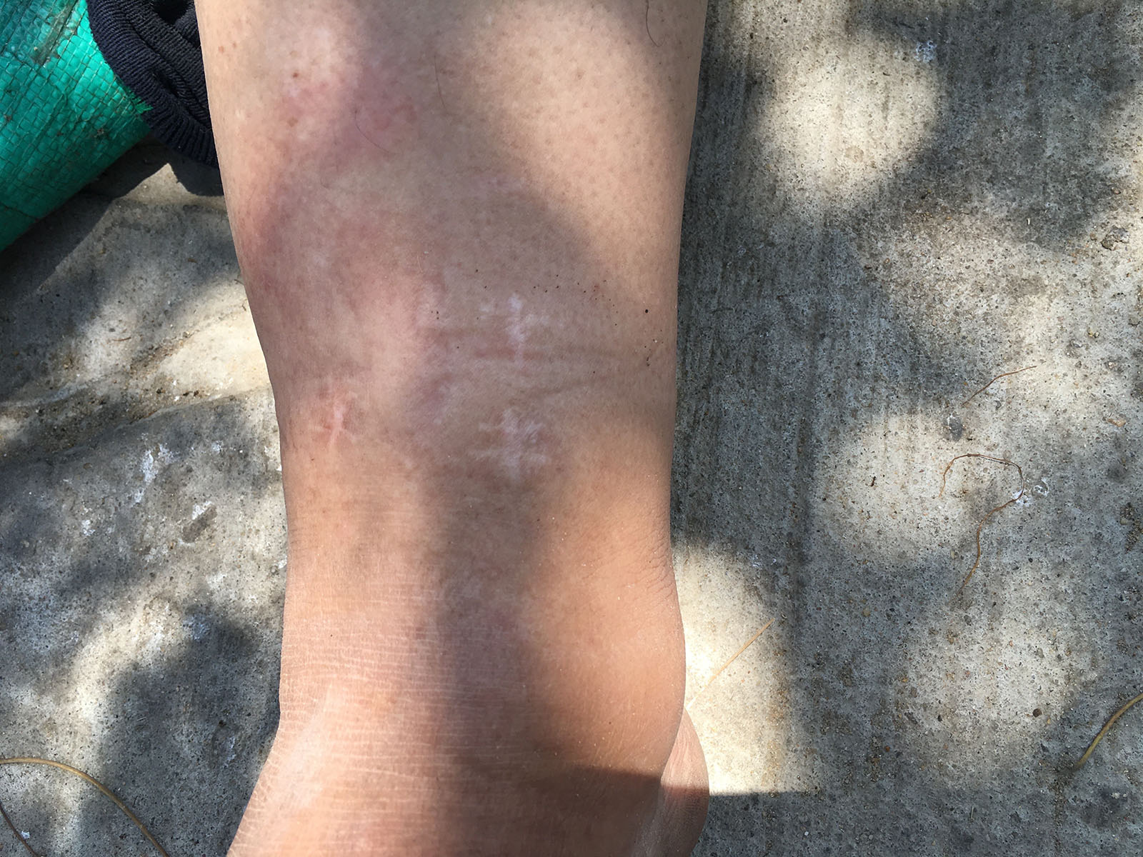 Person #1 - other scar on lower leg