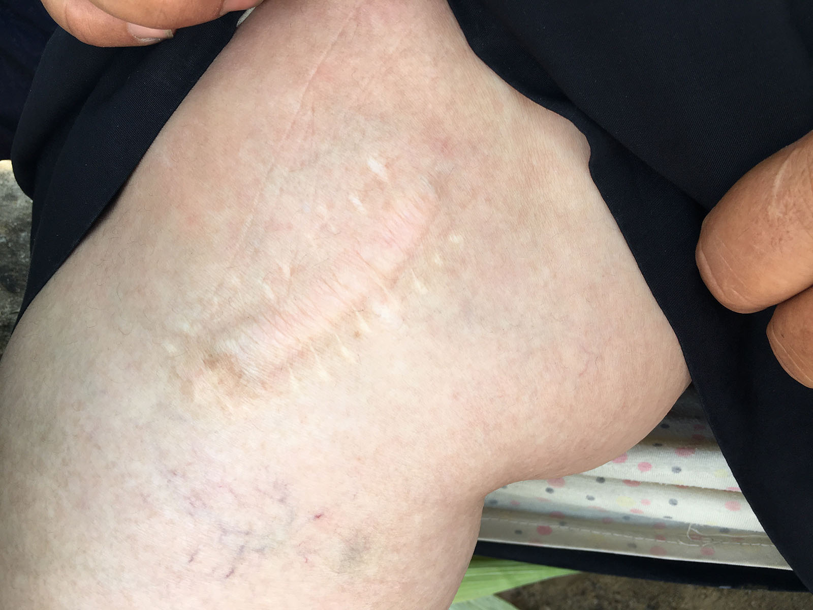 Person #2 - Knee surgery scar